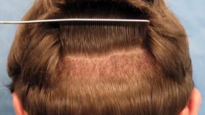 Saç Ekimine Alternatif Yöntemler Neler? 2023 (En Yeni Yöntem)